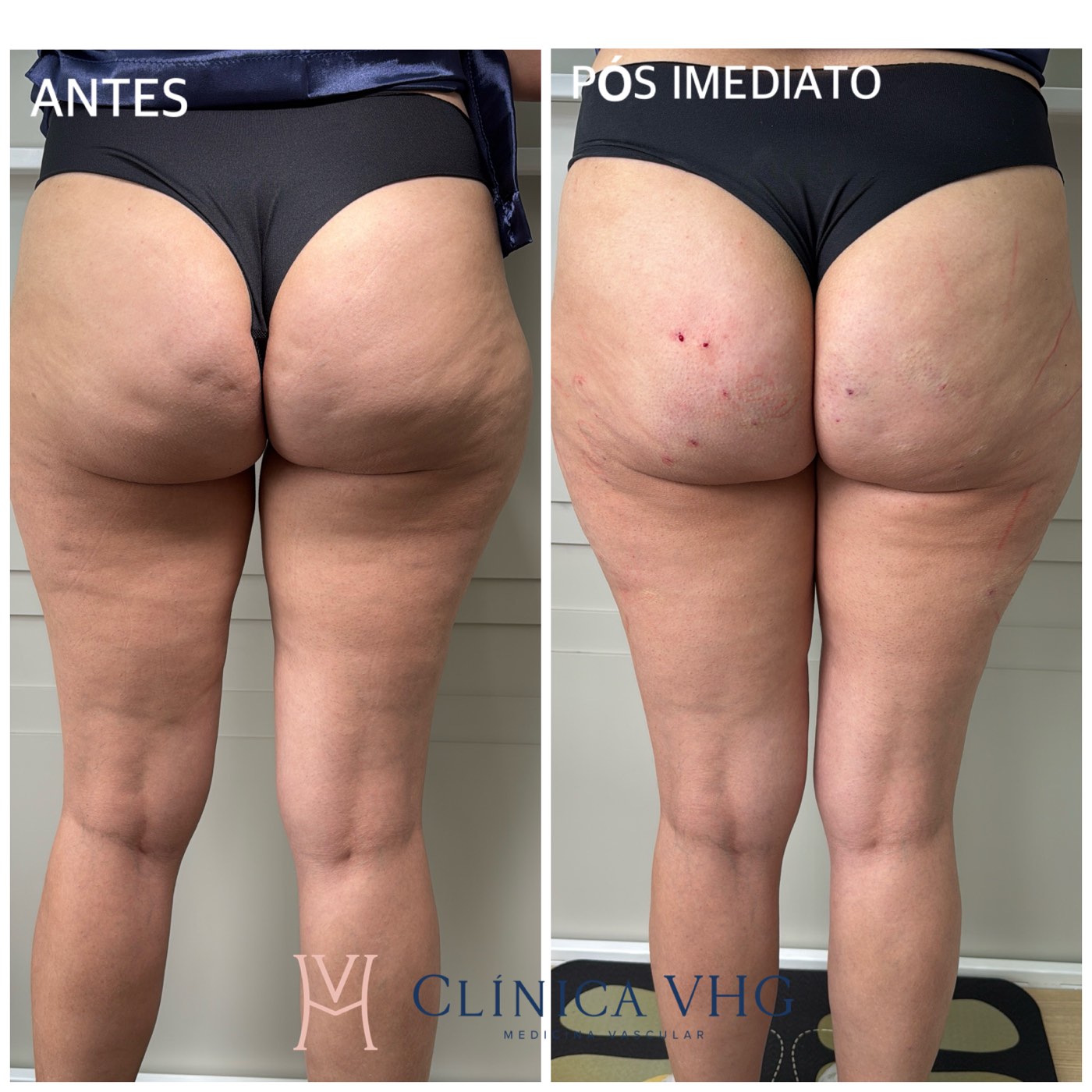 Celulite em glúteos e face posterior das coxas antes e no pós-imediato da subcisão