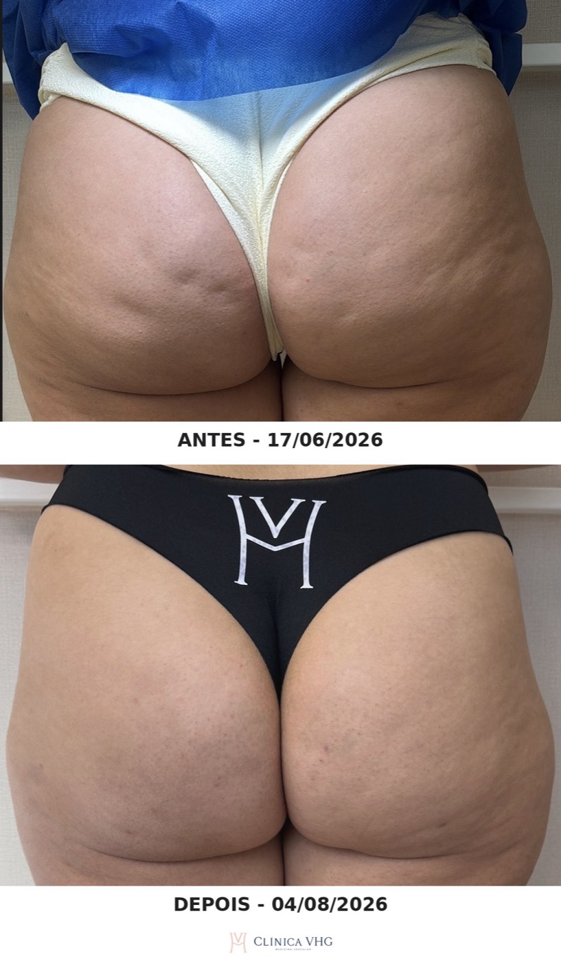 Celulite nos glúteos antes e dois meses depois da subcisão com bioestimulador, paciente da Clínica VHG