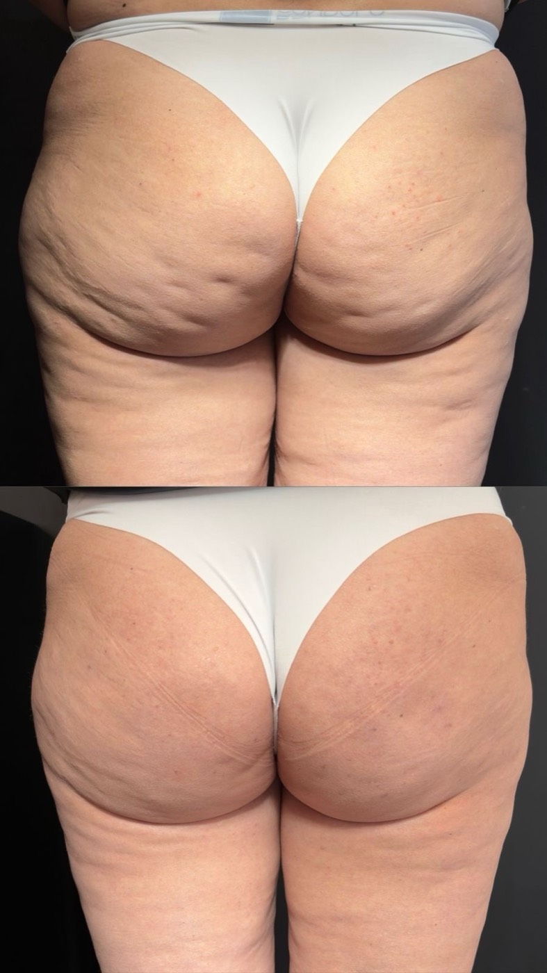 Celulite no glúteo antes e depois da subcisão com bioestimulador de colágeno