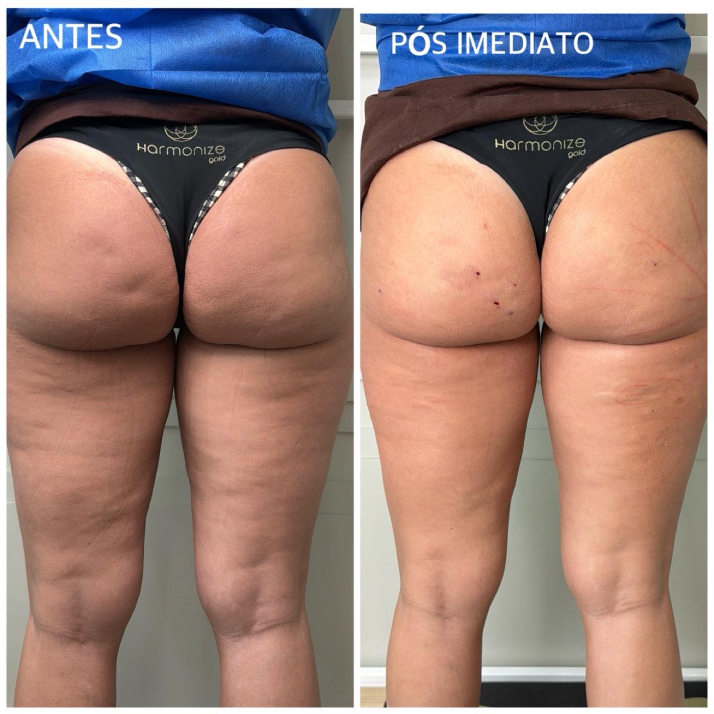 Celulite em glúteos e coxas antes e no pós-imediato da subcisão com bioestimulador