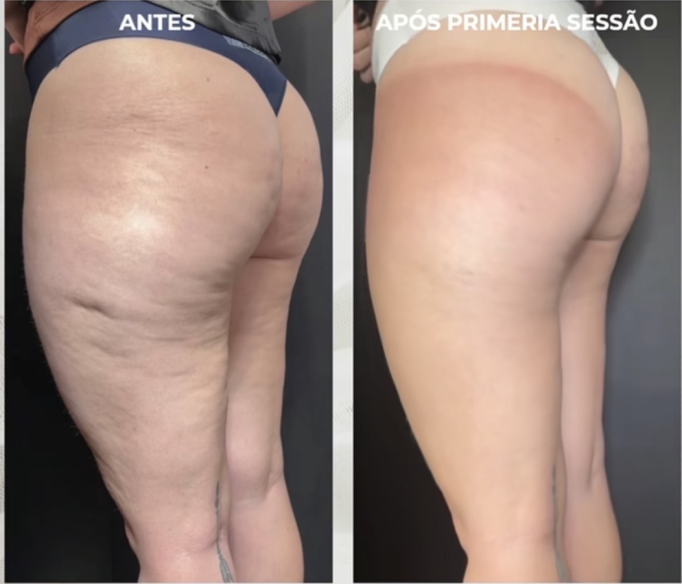 Celulite na lateral da coxa e no glúteo antes e após a primeira sessão de subcisão com bioestimulador