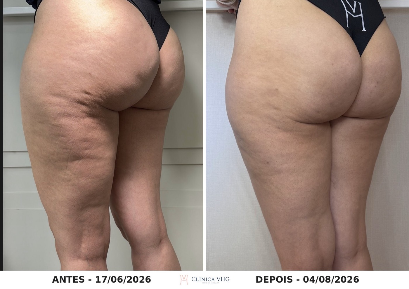 Celulite na lateral da coxa e no glúteo antes e dois meses depois da subcisão com bioestimulador