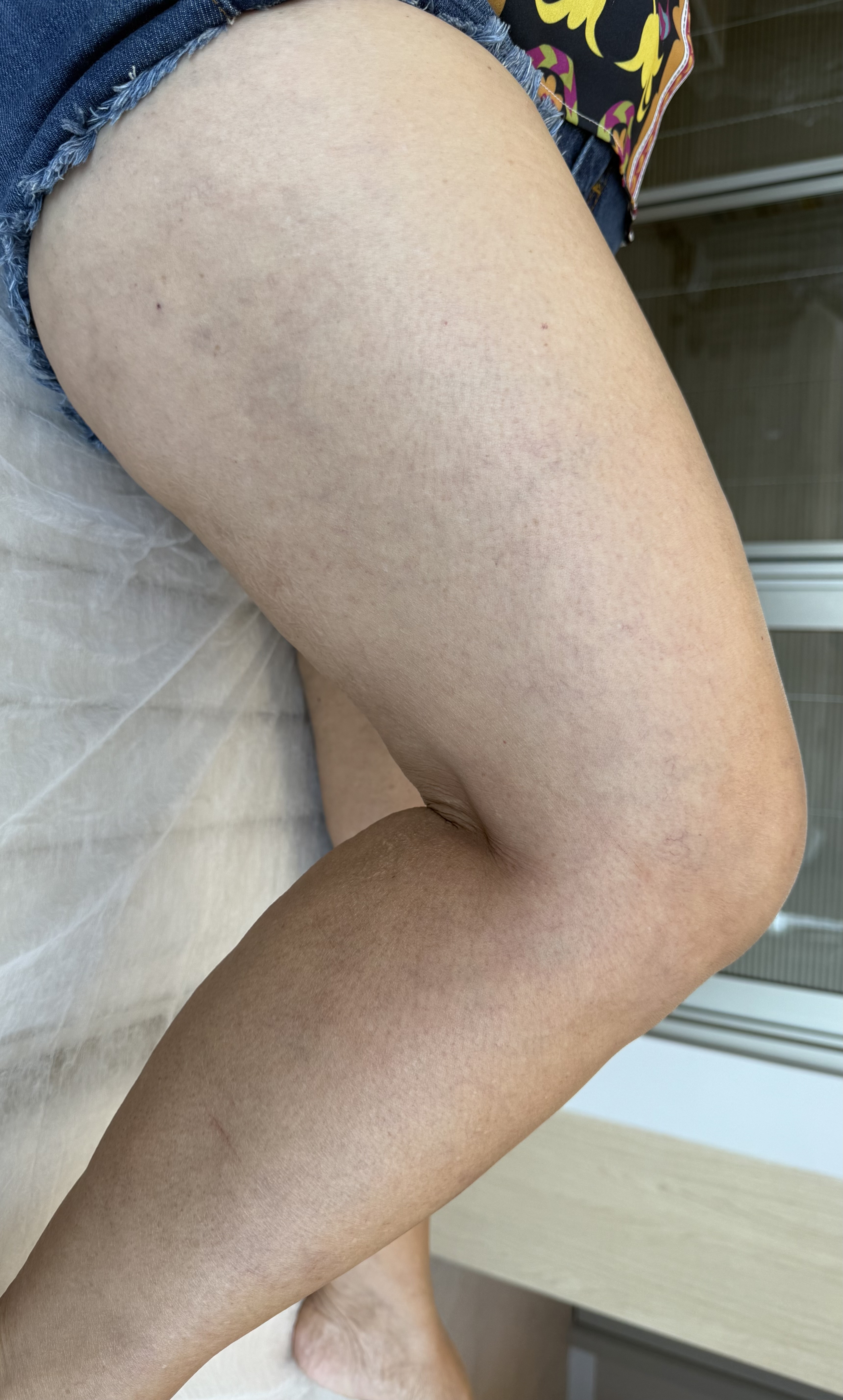 Depois do tratamento de microvarizes e telangiectasias