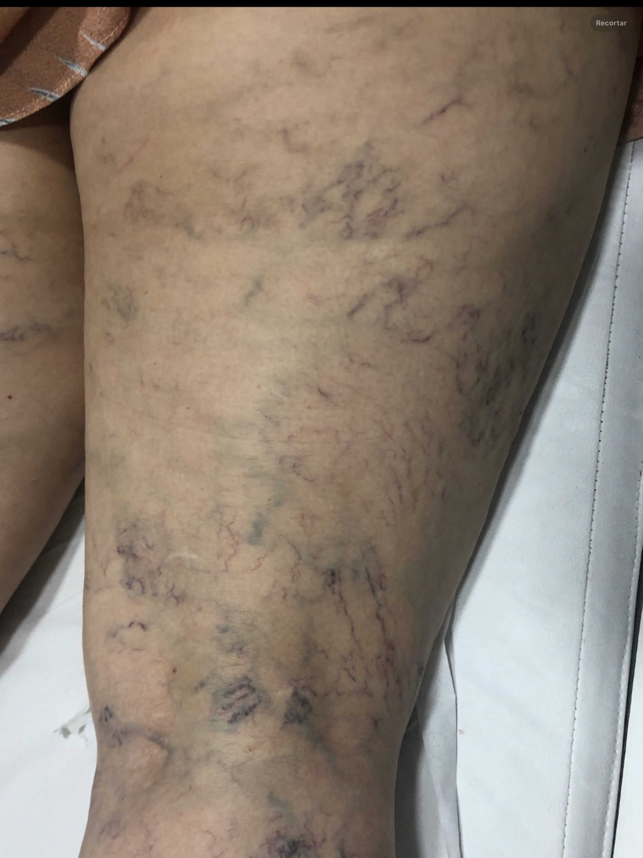 Antes do tratamento completo de varizes