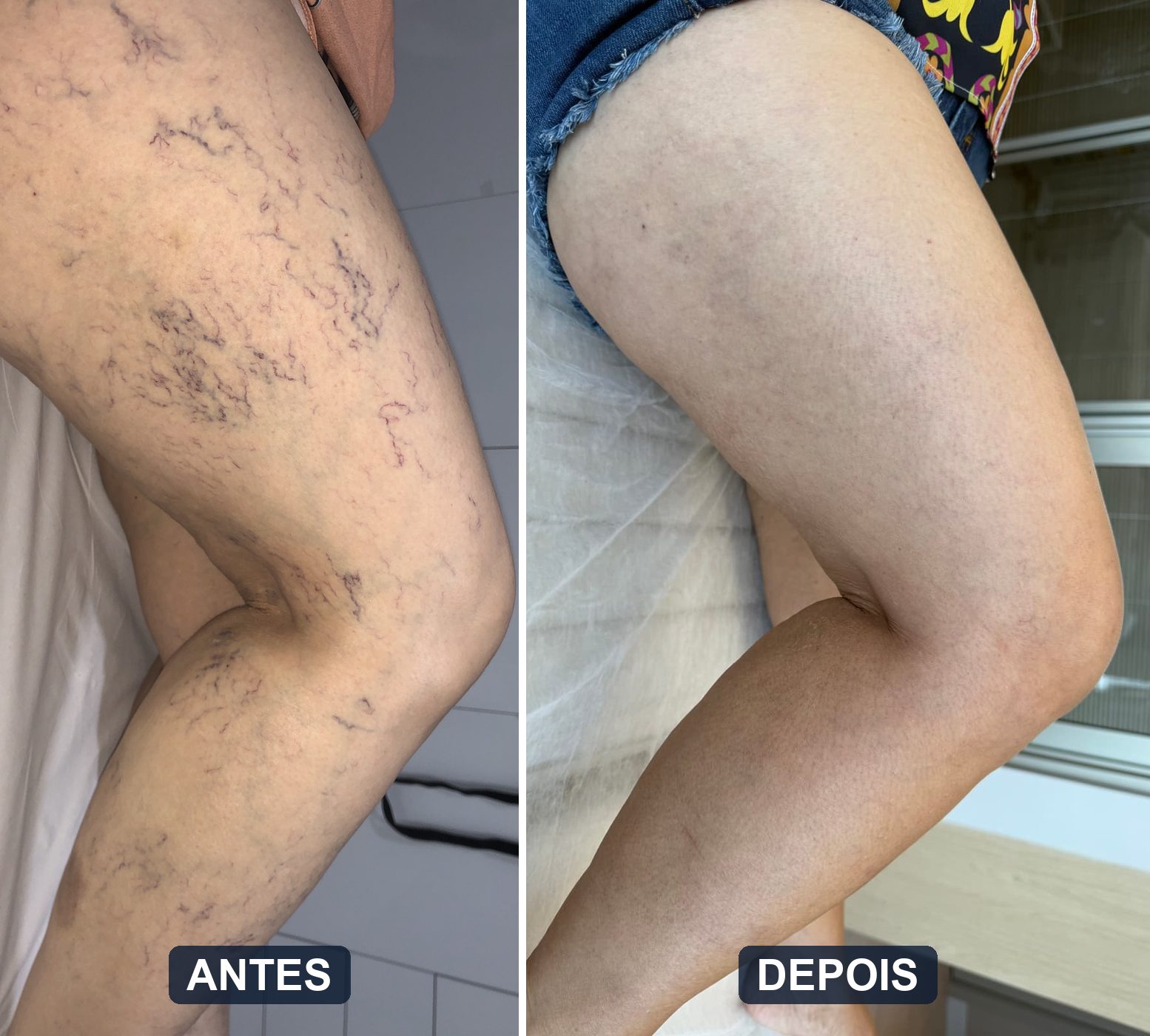 Antes e depois de microvarizes e telangiectasias tratadas com escleroterapia e laser