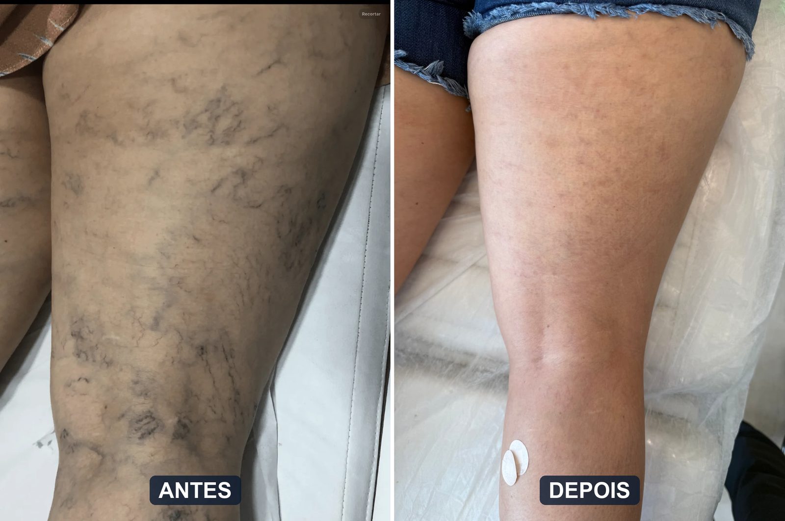 Antes e depois de tratamento completo de varizes com endolaser, escleroterapia e laser transdérmico
