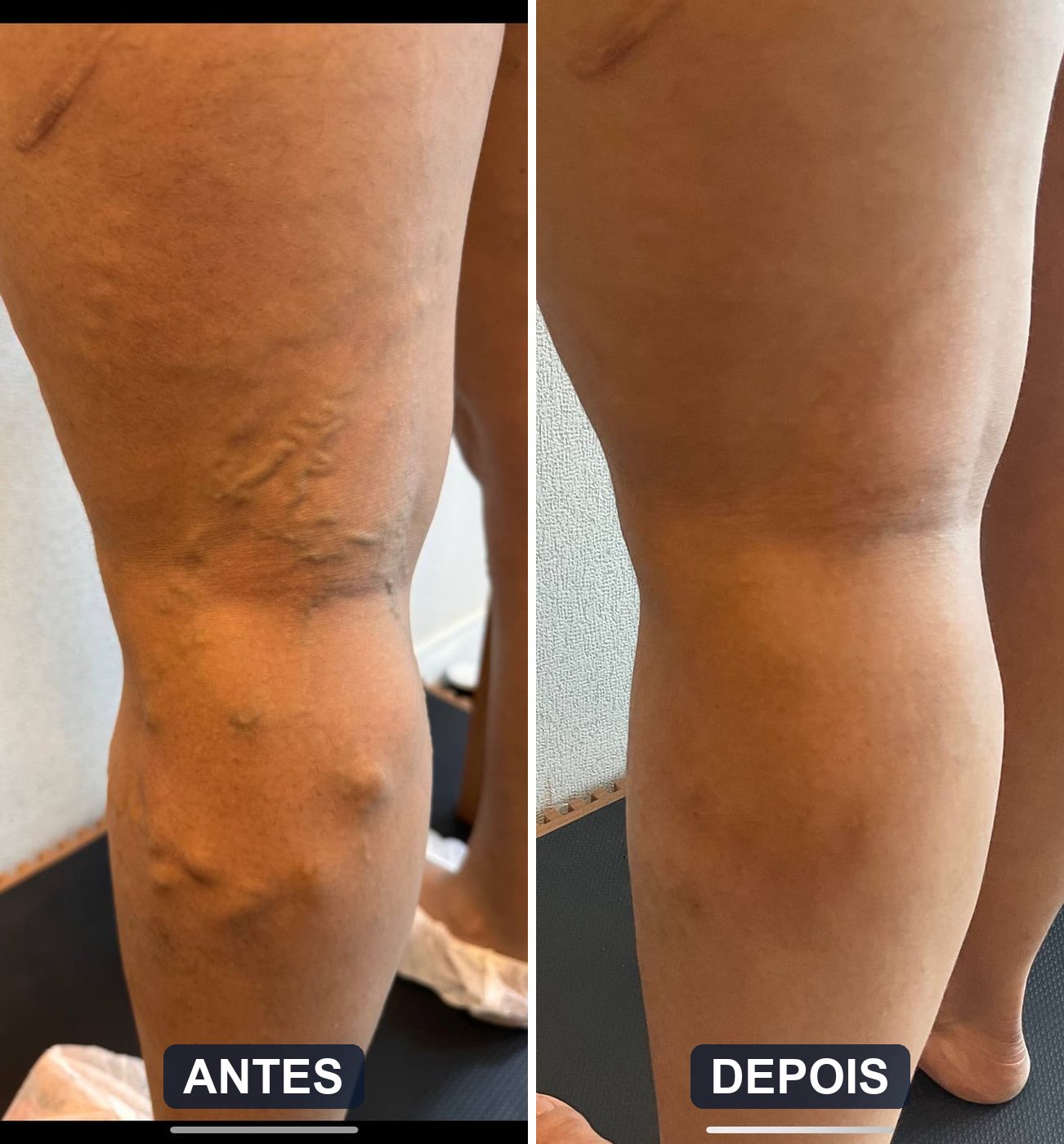 Antes e depois de tratamento da veia safena parva com endolaser