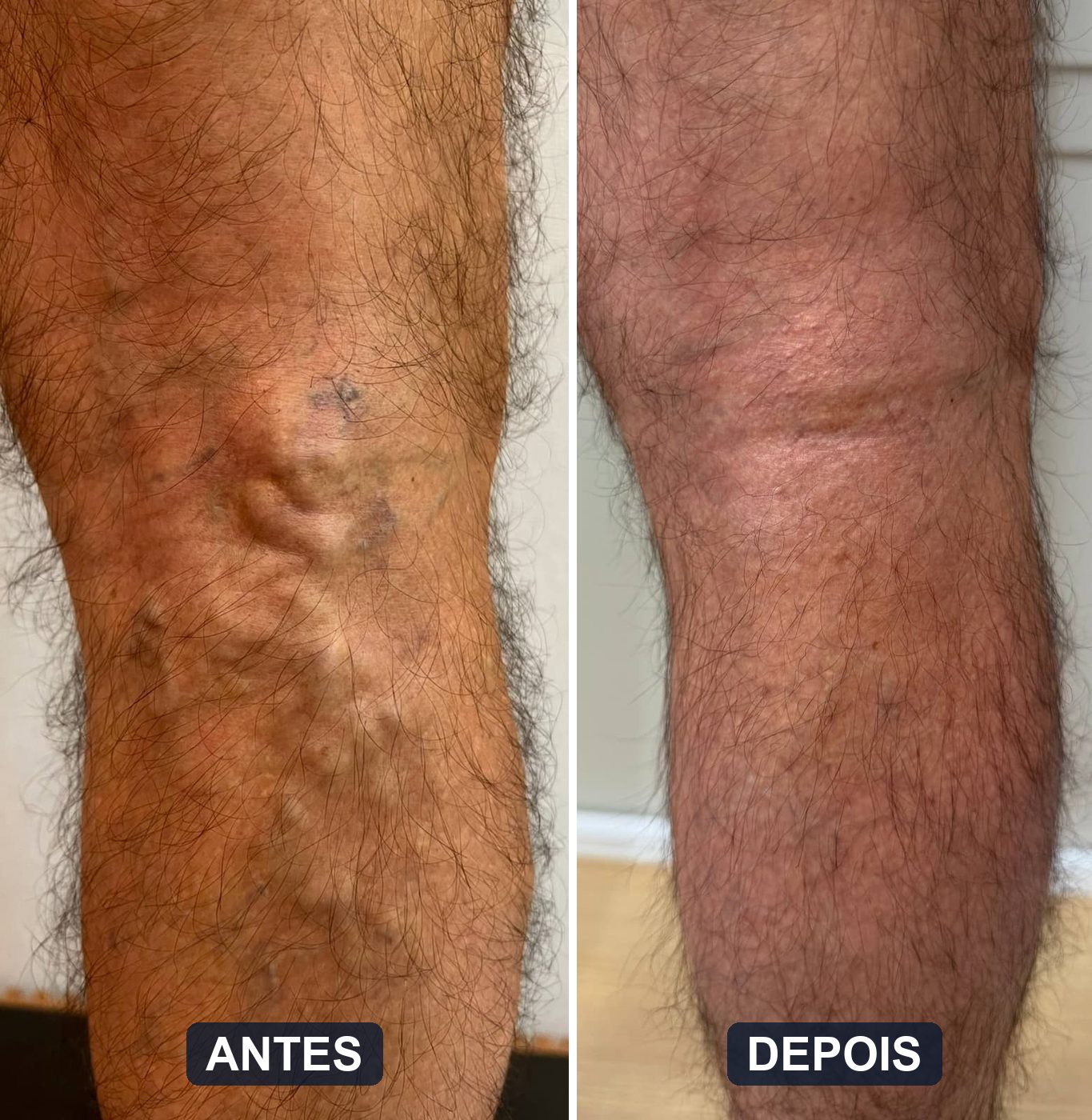 Antes e depois de veias grossas nas pernas tratadas com endolaser