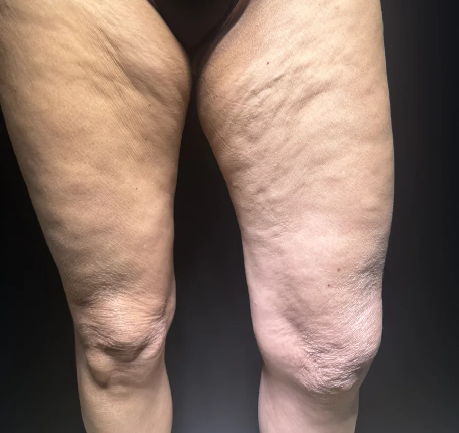 Coxas com flacidez e irregularidades da pele na face anterior