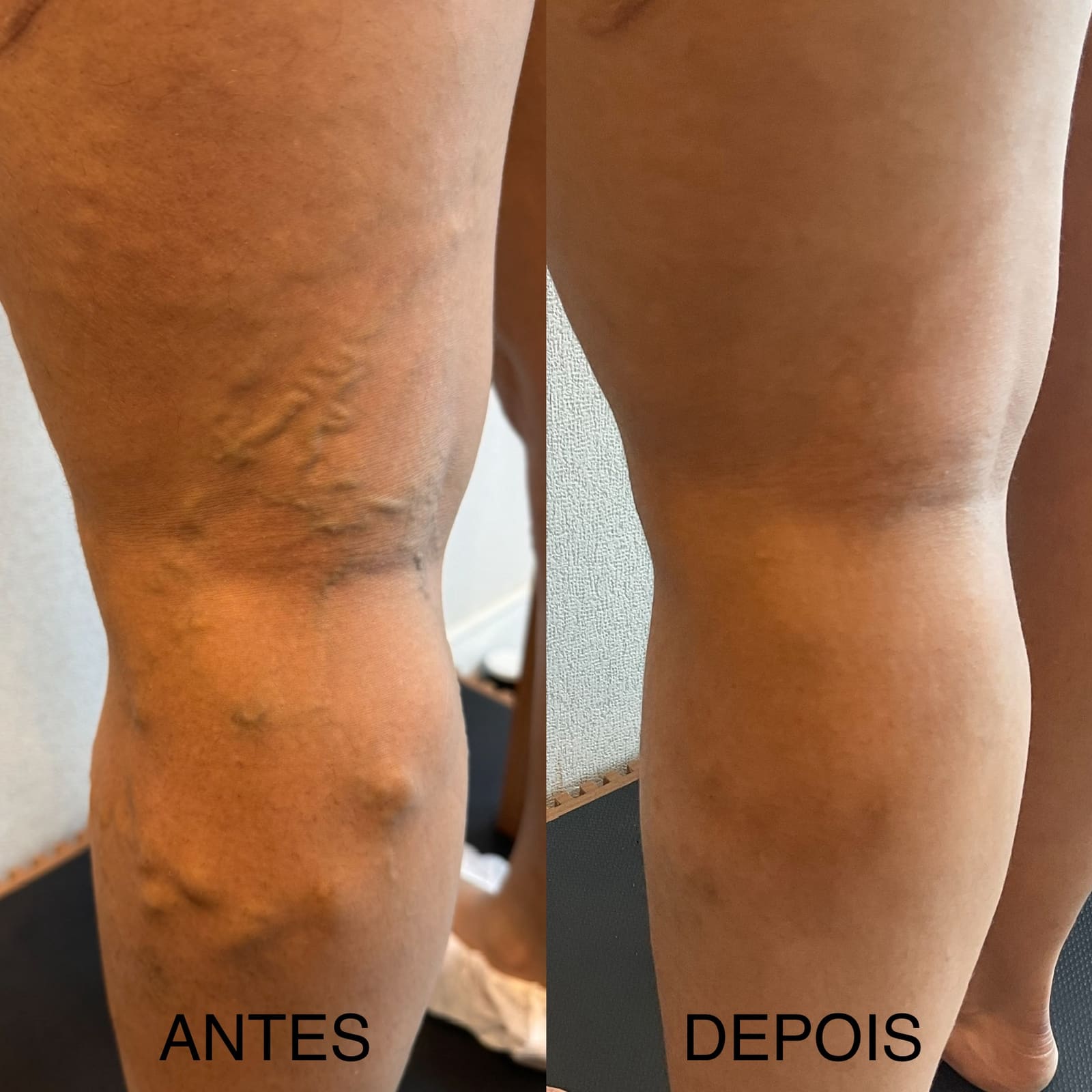 Antes e depois de tratamento de varizes — veias tortuosas em joelho e perna