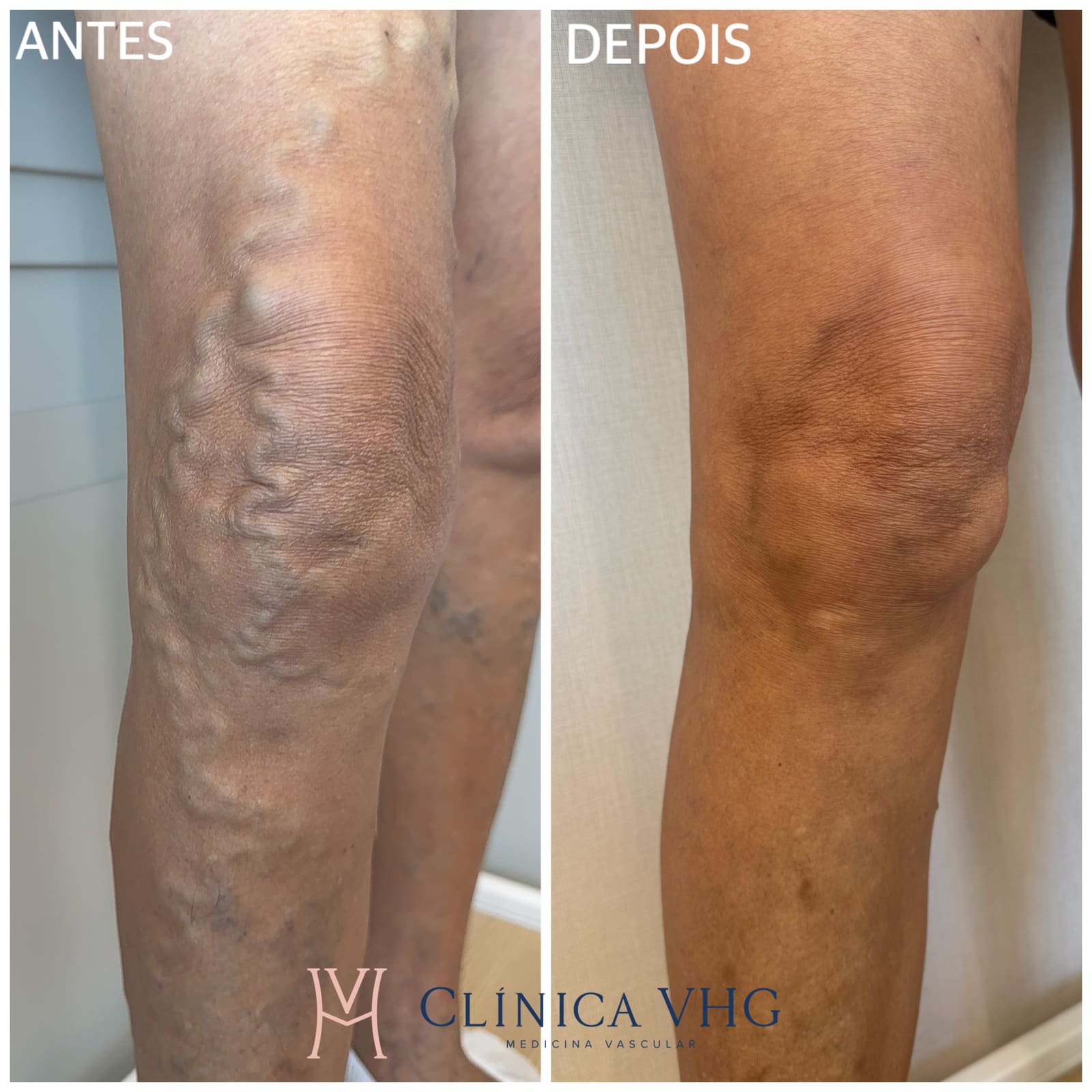 Antes e depois de tratamento de varizes — varizes em face medial do joelho