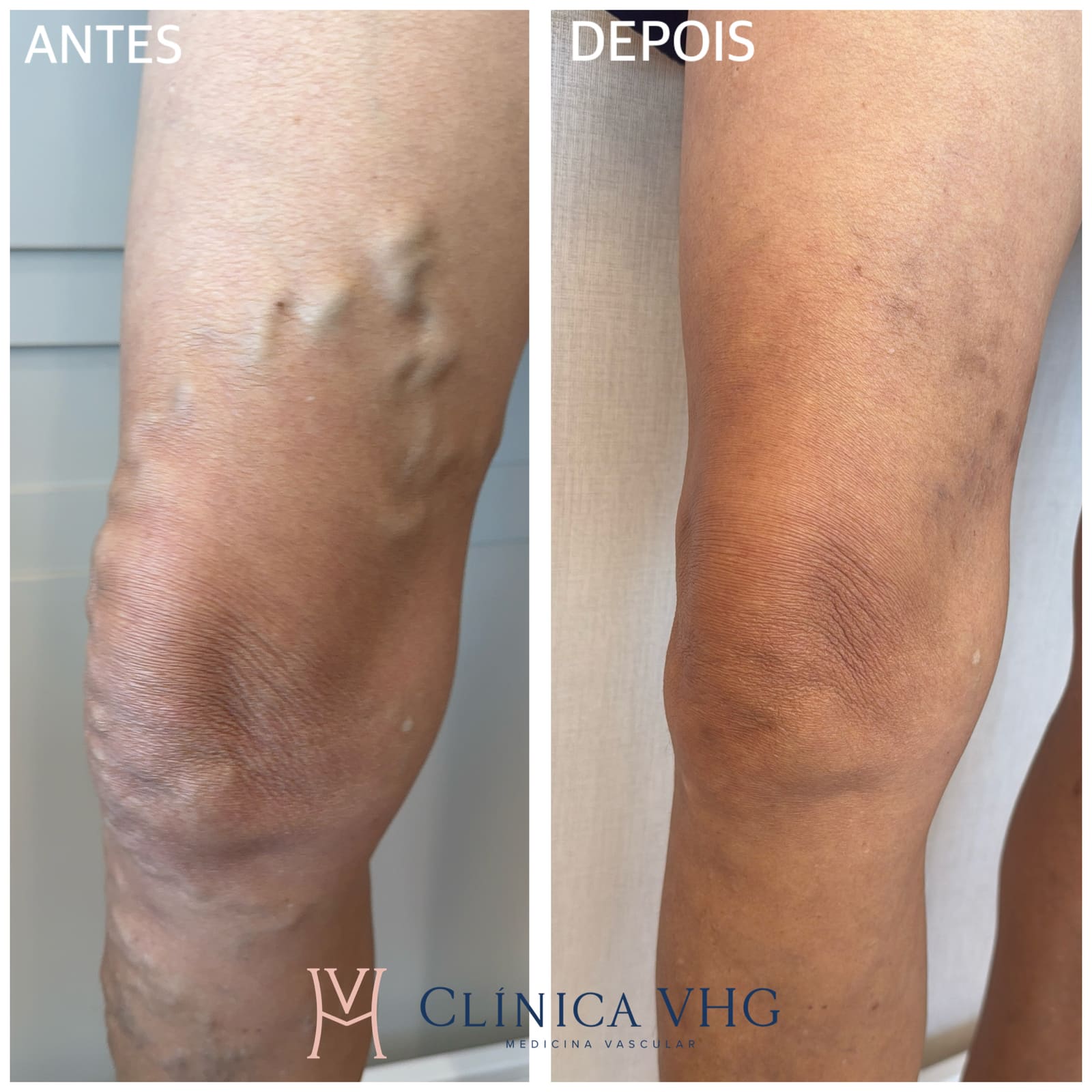Antes e depois de tratamento de varizes — rede varicosa em joelho