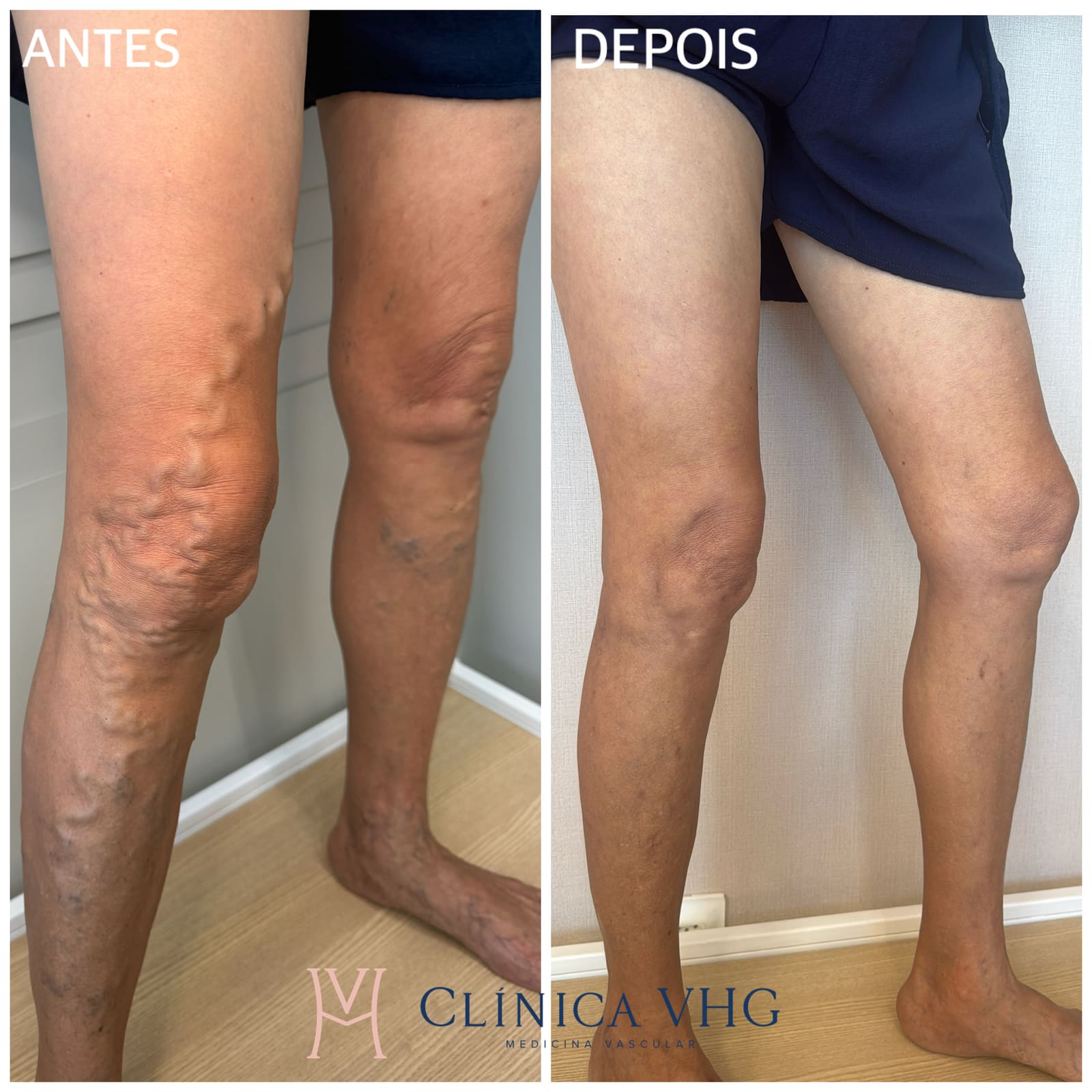 Antes e depois de tratamento de varizes — varizes extensas em membro inferior