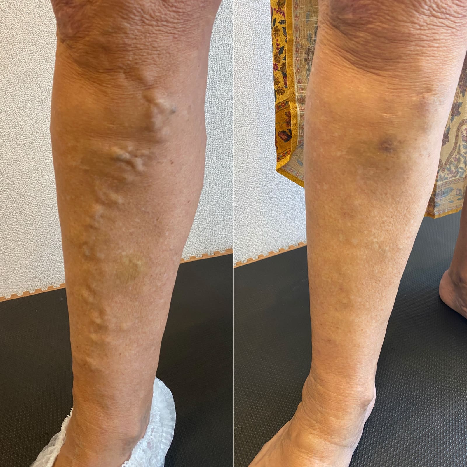 Antes e depois de tratamento de varizes — cordões varicosos em perna