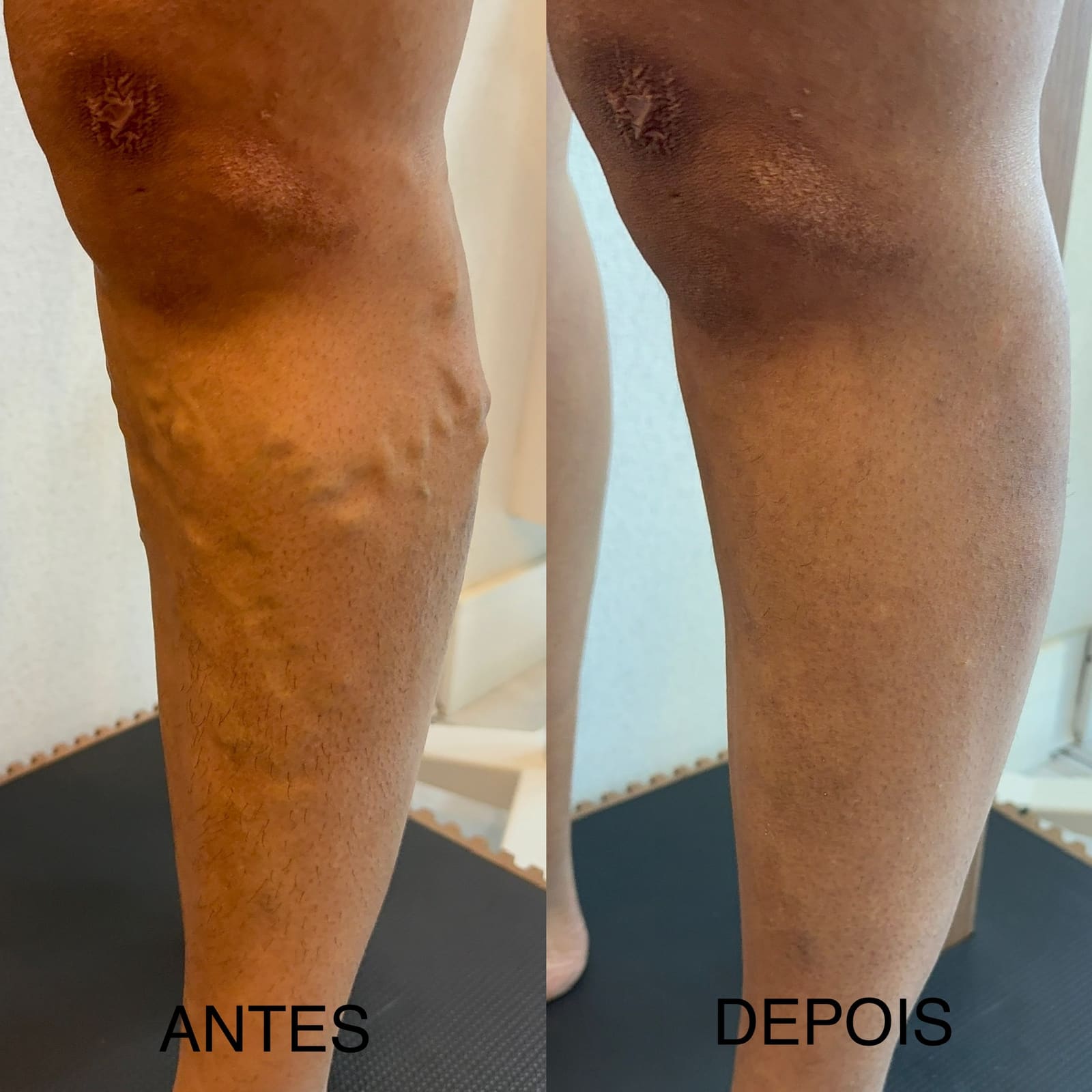 Antes e depois de tratamento de varizes — vasos calibrosos em joelho e perna