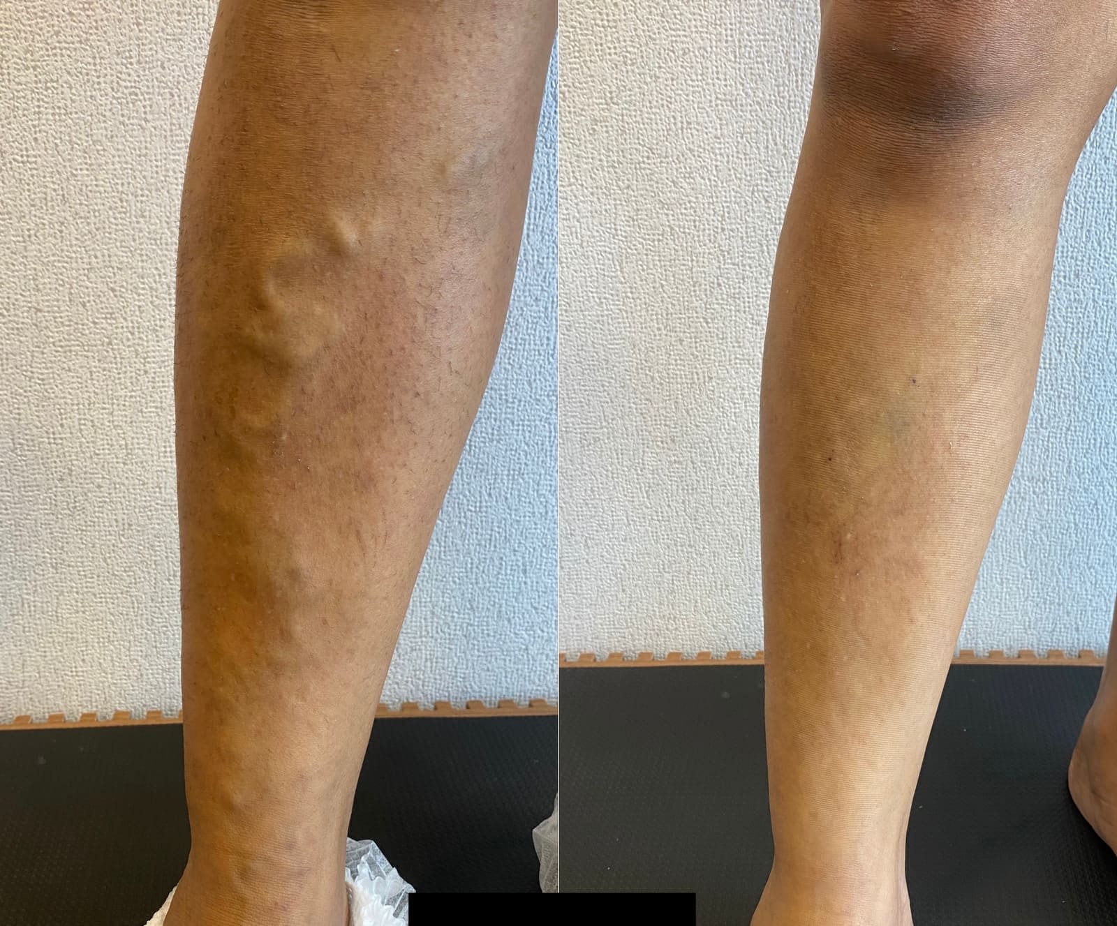 Antes e depois de tratamento de varizes — varizes em perna