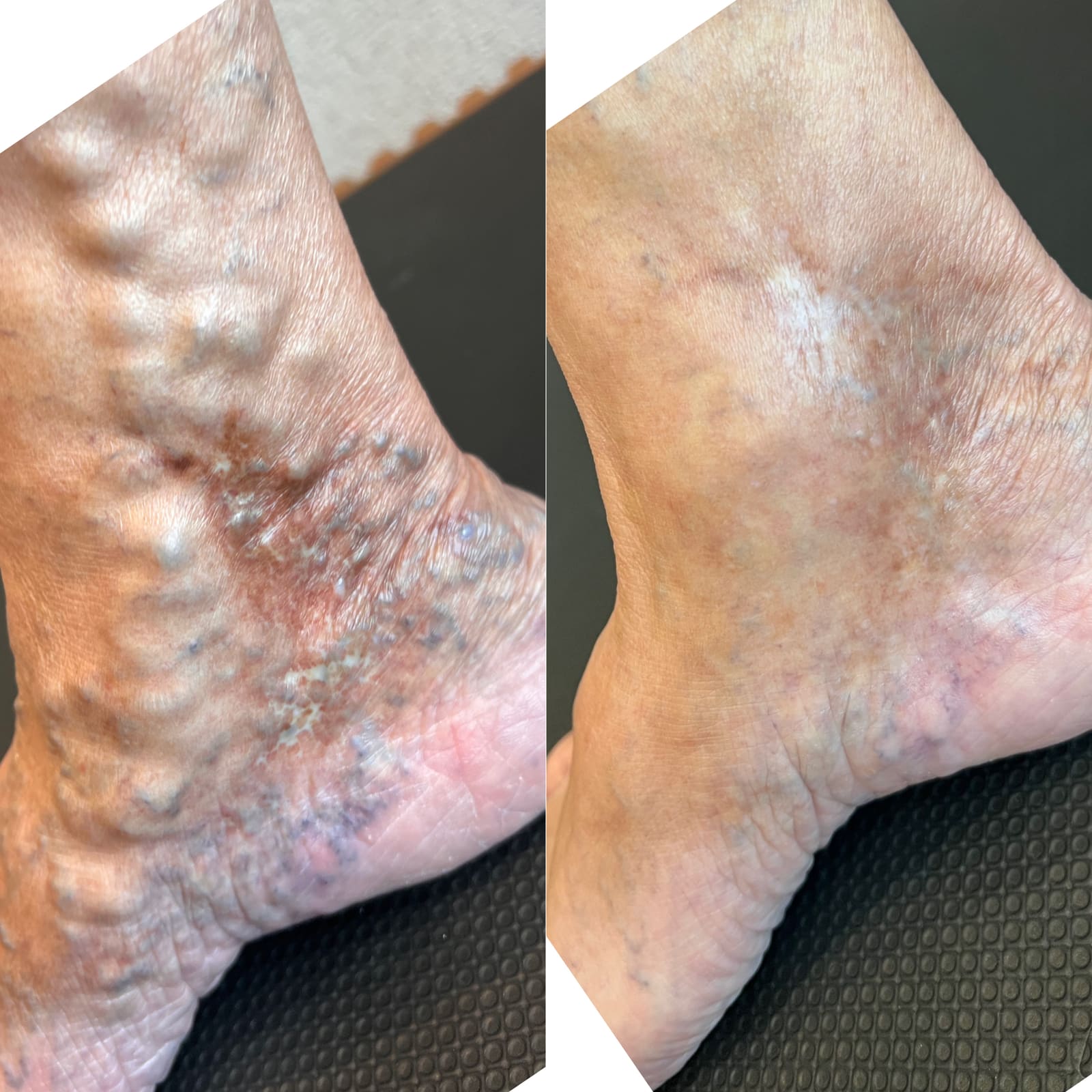 Antes e depois de tratamento de varizes — dermatite e varizes em tornozelo