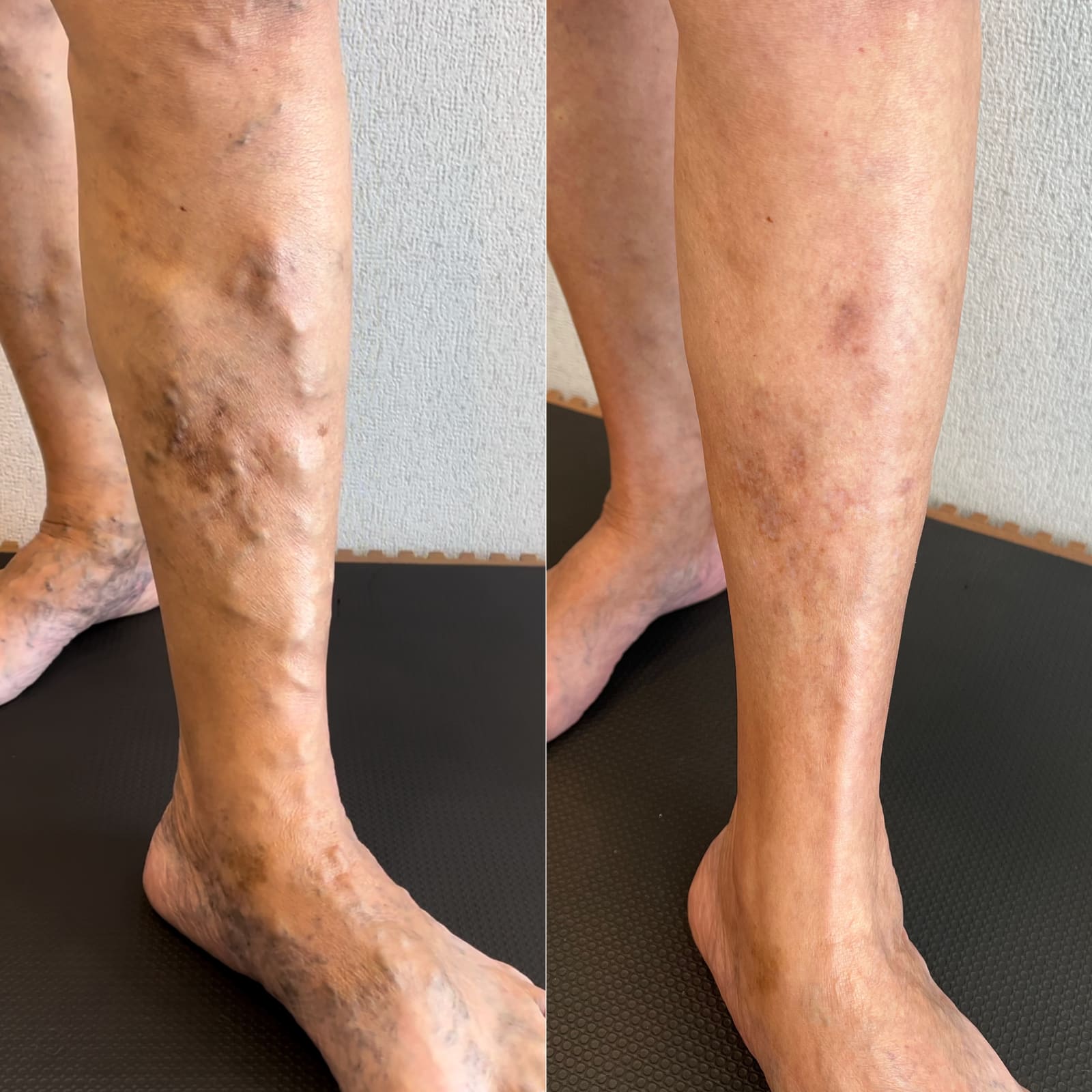 Antes e depois de tratamento de varizes — alterações de pele em perna e tornozelo