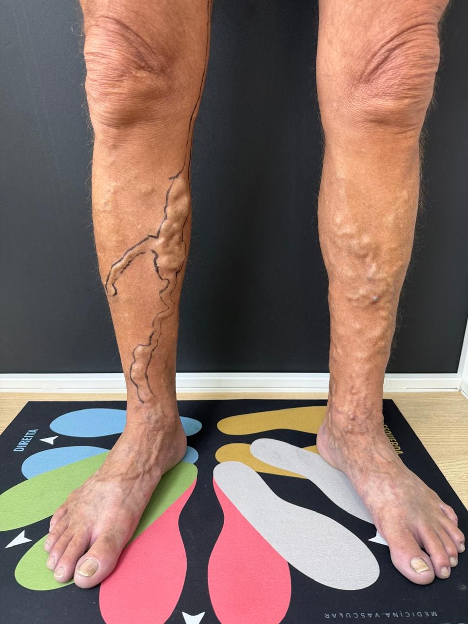 Demarcação das veias com a paciente em pé