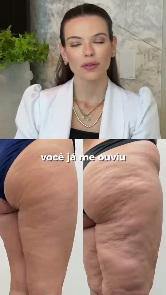 Lipedema e tratamentos estéticos: quando começar a tratar celulite e flacidez