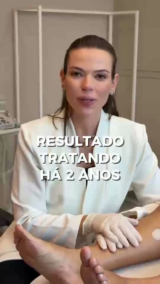 Manutenção após tratamento de varizes: o que fazer para continuar bem