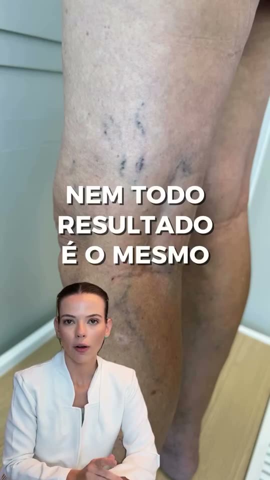 Tipos de vasinhos nas pernas: cada um pede um tratamento