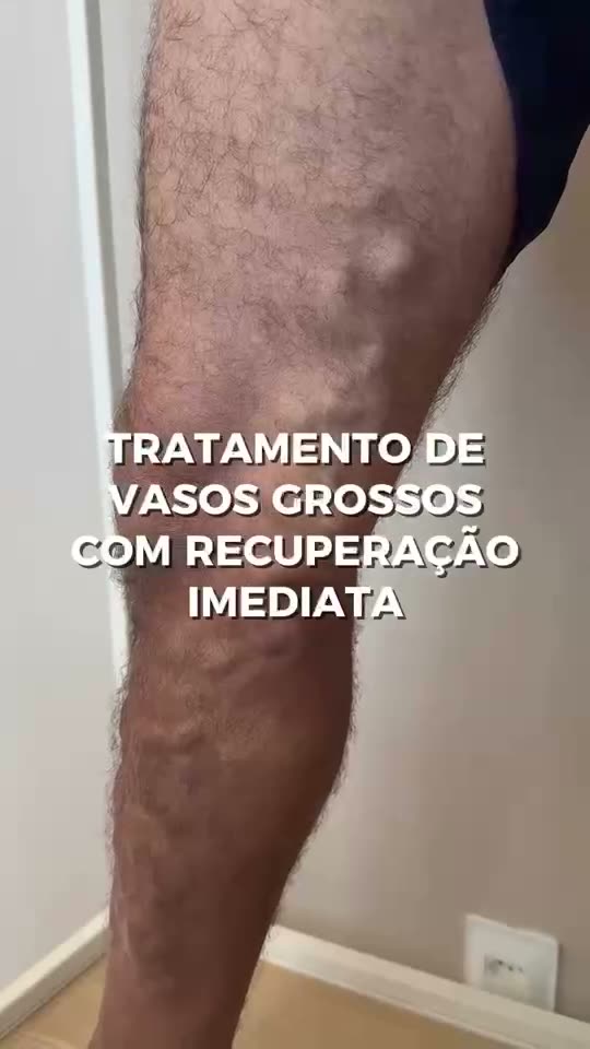 Veias grossas na coxa: por que aparecem e como tratar sem cortes